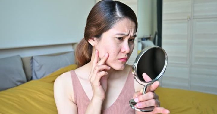 去痘印產品推薦